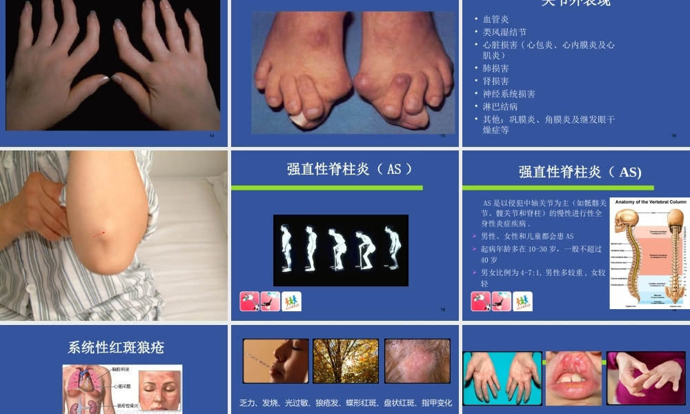 8风湿免疫科-风湿病的锻炼方法(1).ppt