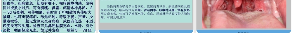 9.13急性上呼吸道感染.pptx