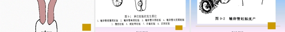 9流产、异位妊娠、过期妊娠.pptx