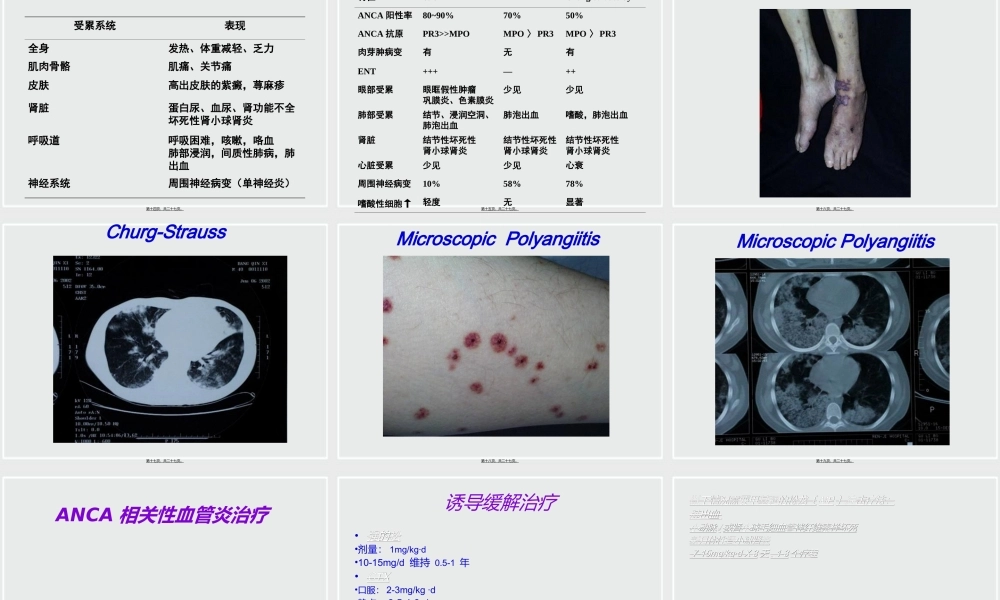 ANCA相关性小血管炎诊治进展.ppt