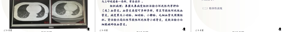 ANCA相关性血管炎病例分析.pptx