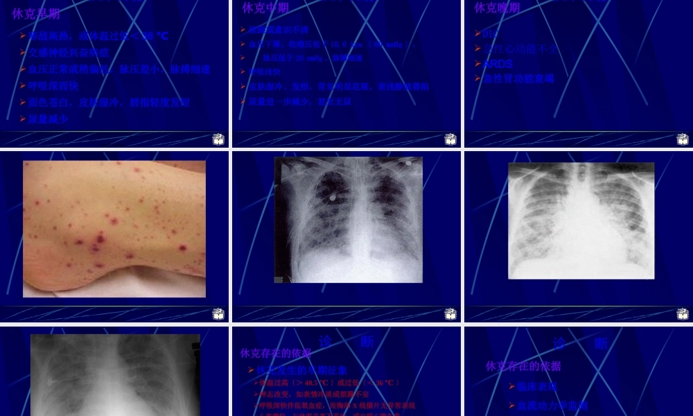 CP感染性休克.pptx