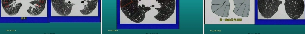 CT(胸部)读片(西京医院).pptx