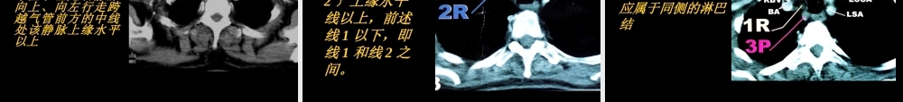 CT展示纵隔淋巴结新分区.pptx