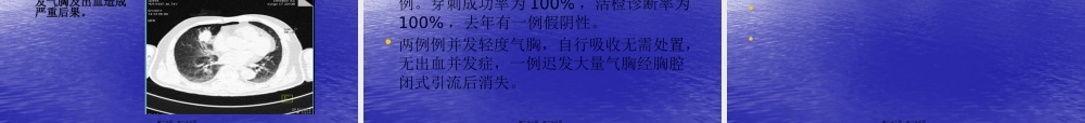 CT导引下肺穿刺活检术.pptx
