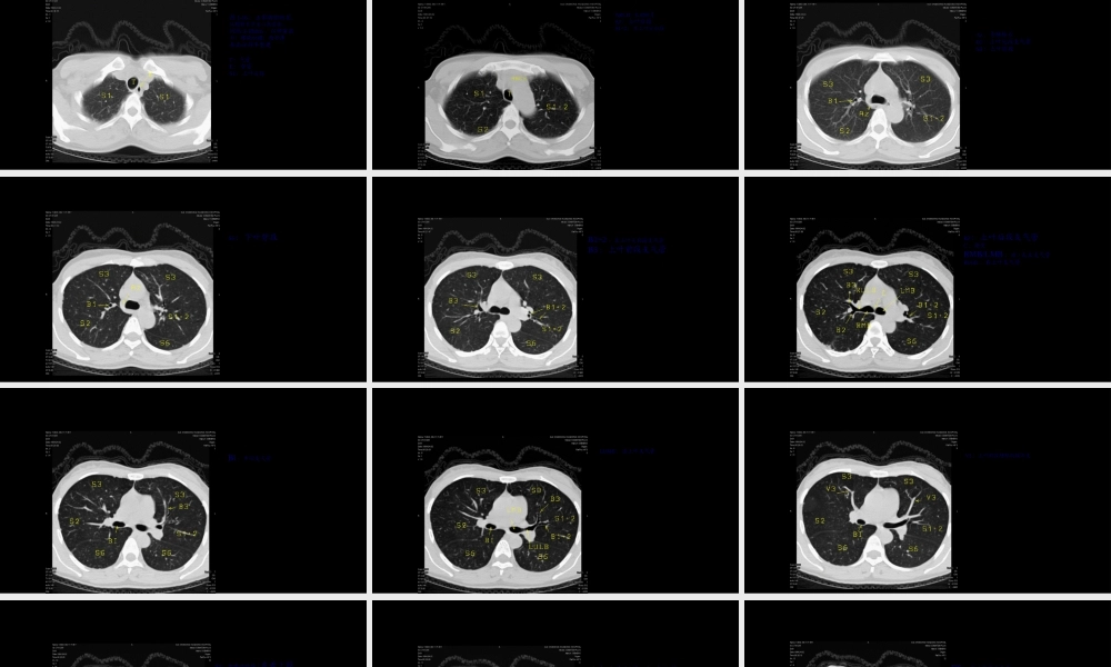 CT肺叶分段及纵膈淋巴结分组.ppt