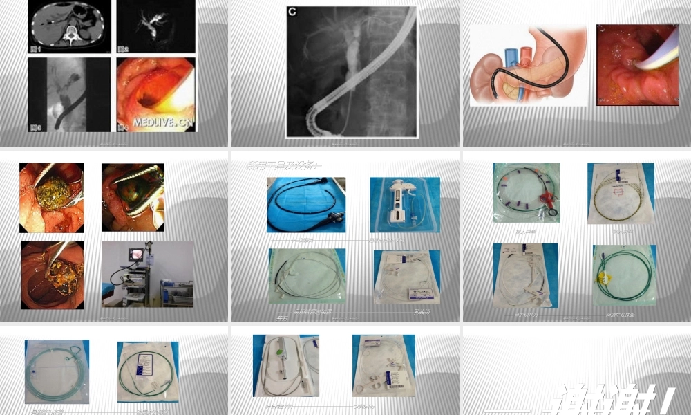 ERCP+EST取石术.ppt