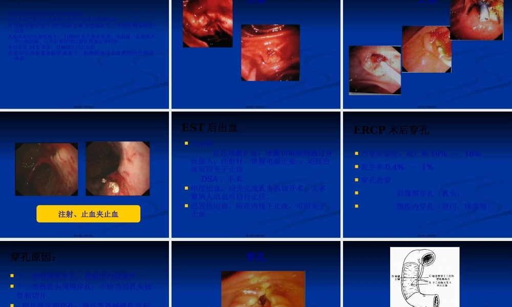 ERCP并发症的认识.pptx