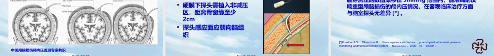 ICP在颅脑创伤中的应用.pptx