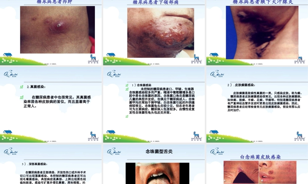 8.24糖尿病患者的皮肤表现.pptx