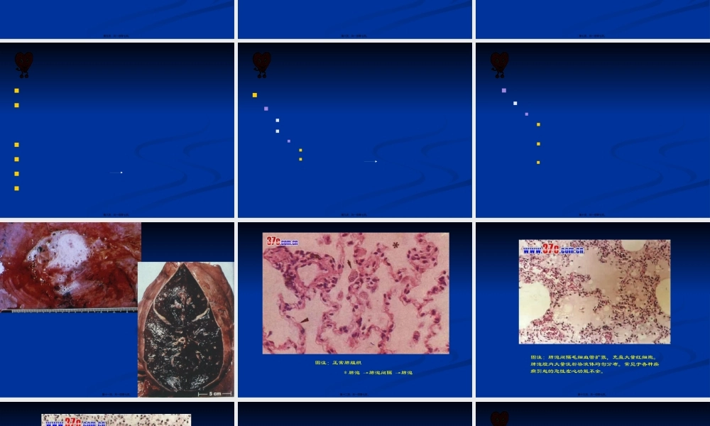 Chapter-3-血液循环障碍.pptx