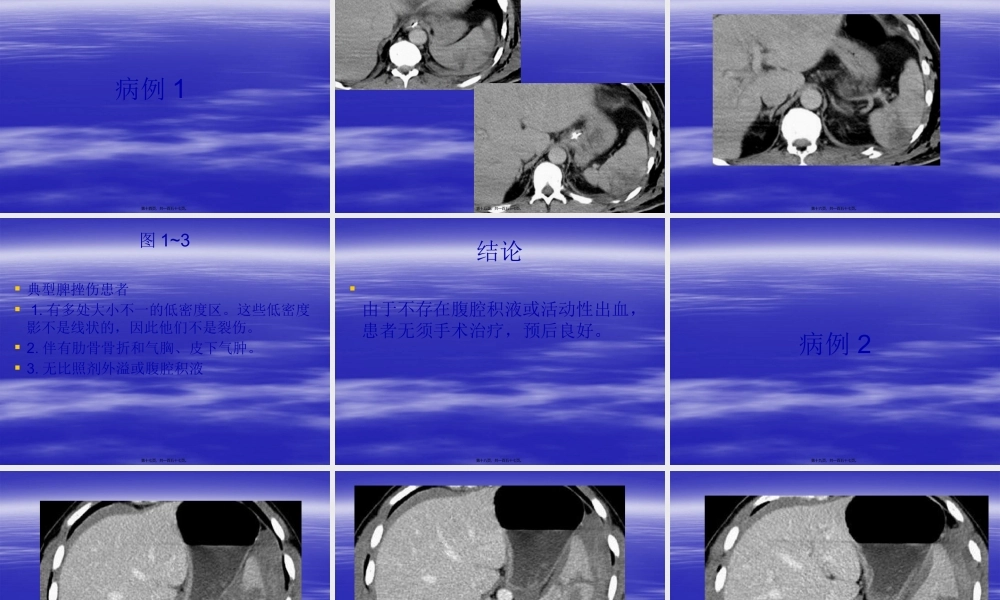 CT在腹部外伤中的应用概述.pptx