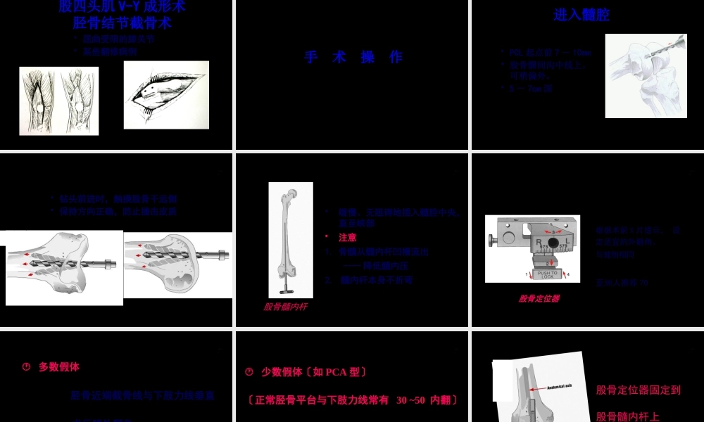 DePuy全膝关节置换手术-0.pptx