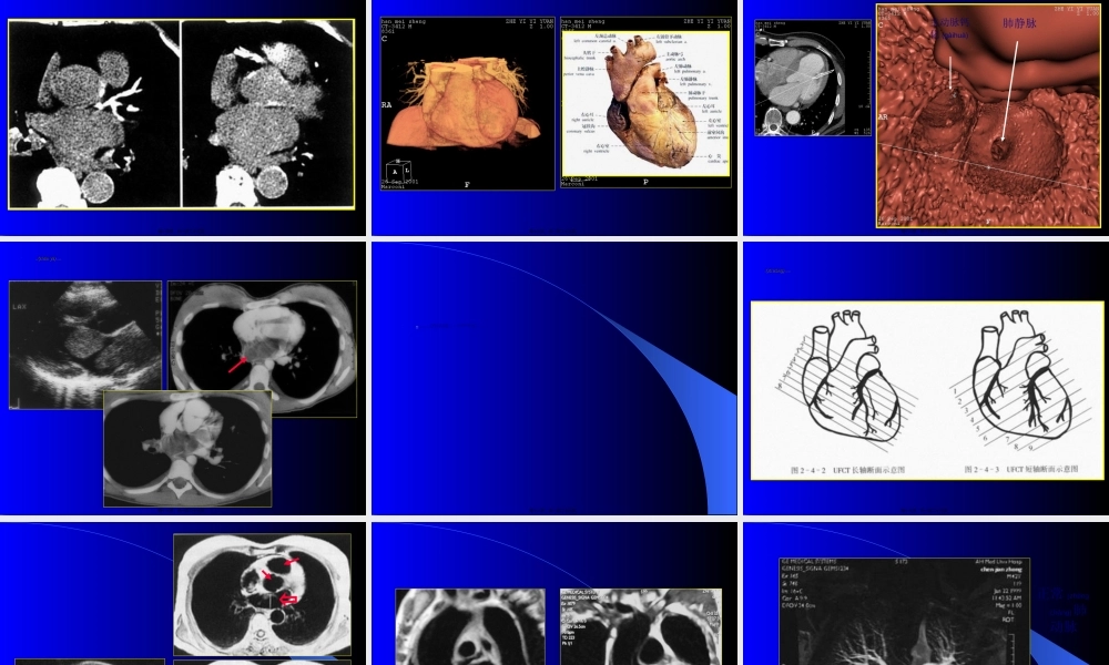 2022年医学专题—心脏与大血管影象.ppt