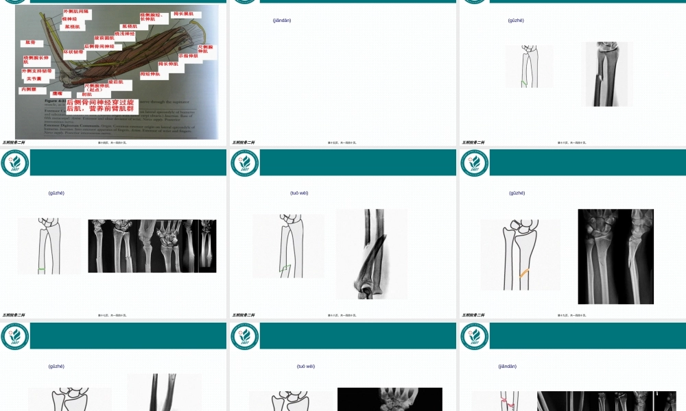 2022年医学专题—前臂骨折.ppt