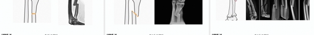 2022年医学专题—前臂骨折.ppt