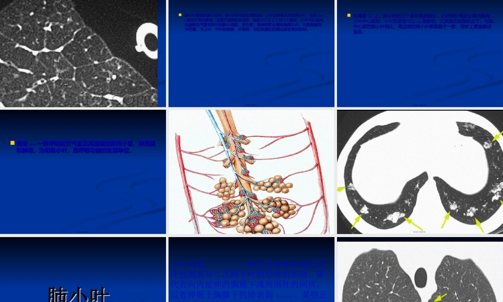 2022年医学专题—胸部CT影像征象高清图解.ppt