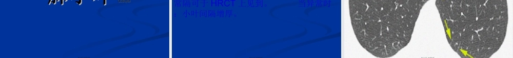 2022年医学专题—胸部CT影像征象高清图解.ppt