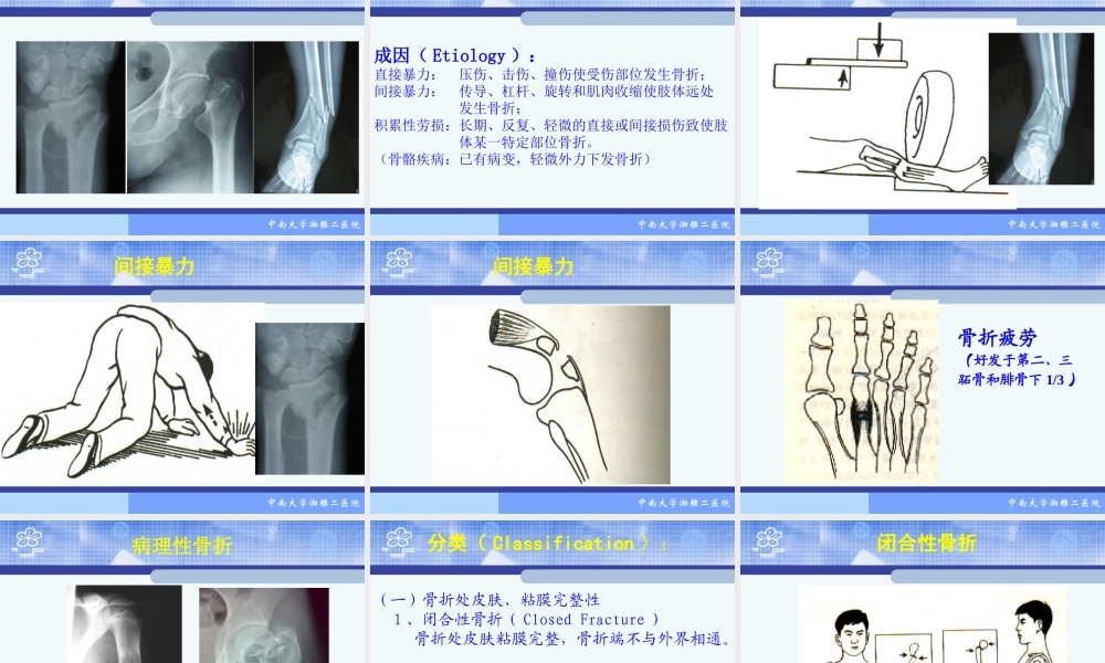 20骨科-骨折概论（修改）(1).ppt