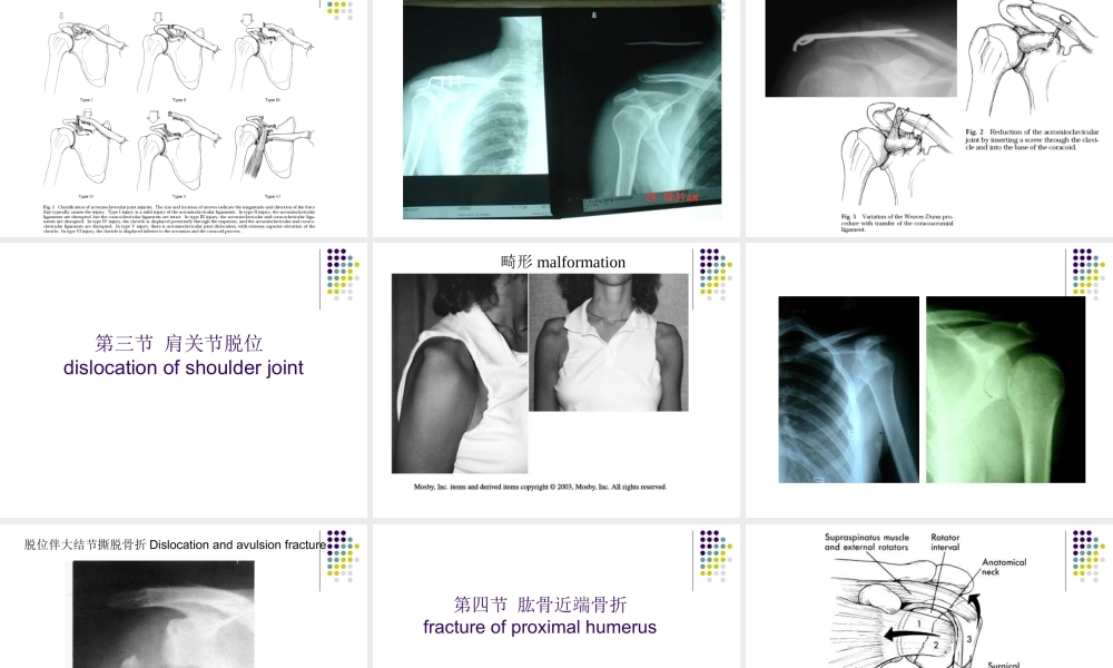 21骨科-骨折各论-shuangyu-new(1).ppt