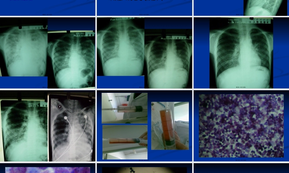 IPH病例讨论.pptx