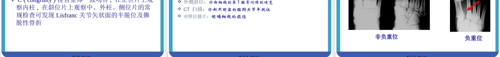 Lisfranc-损伤.pptx