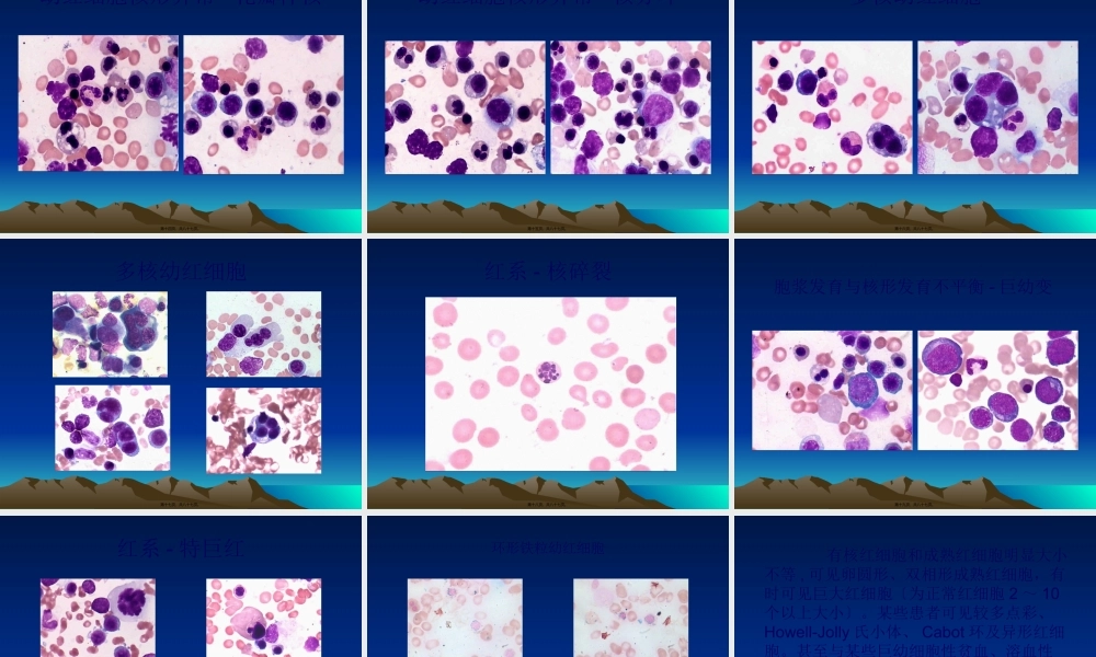 MDS的分型及细胞形态改变.pptx