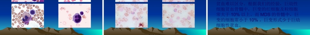 MDS的分型及细胞形态改变.pptx