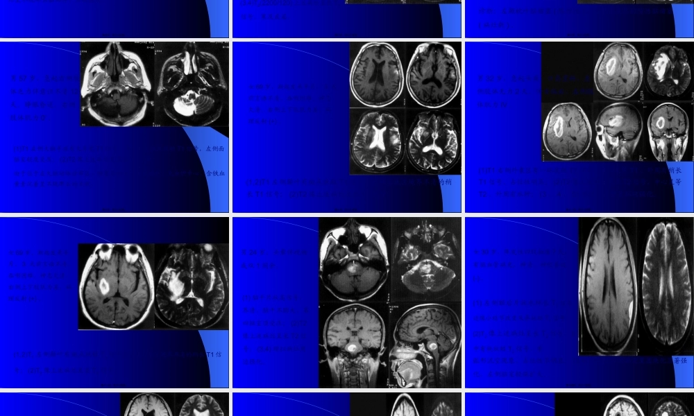 MRI图像-脑-01.pptx