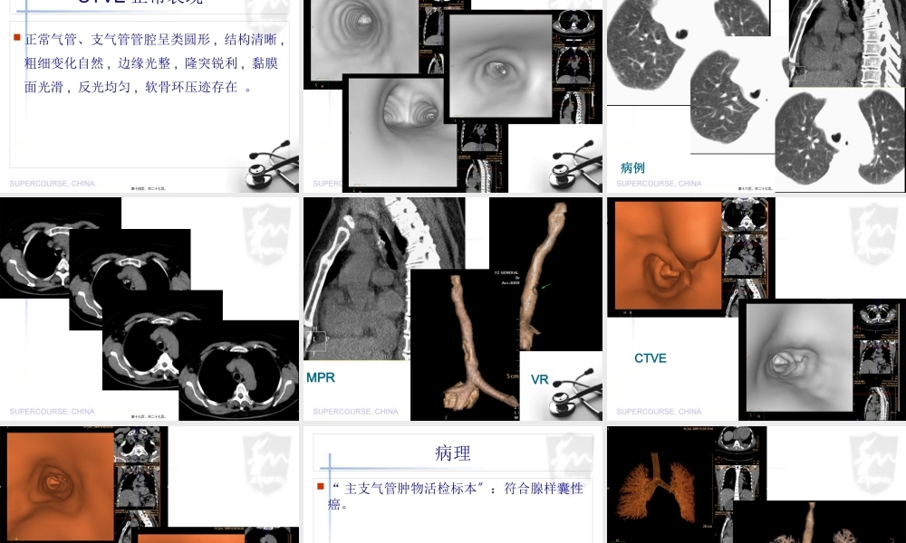 MSCT图像后处理技术对中央型肺癌气管、支气管树的应用.pptx