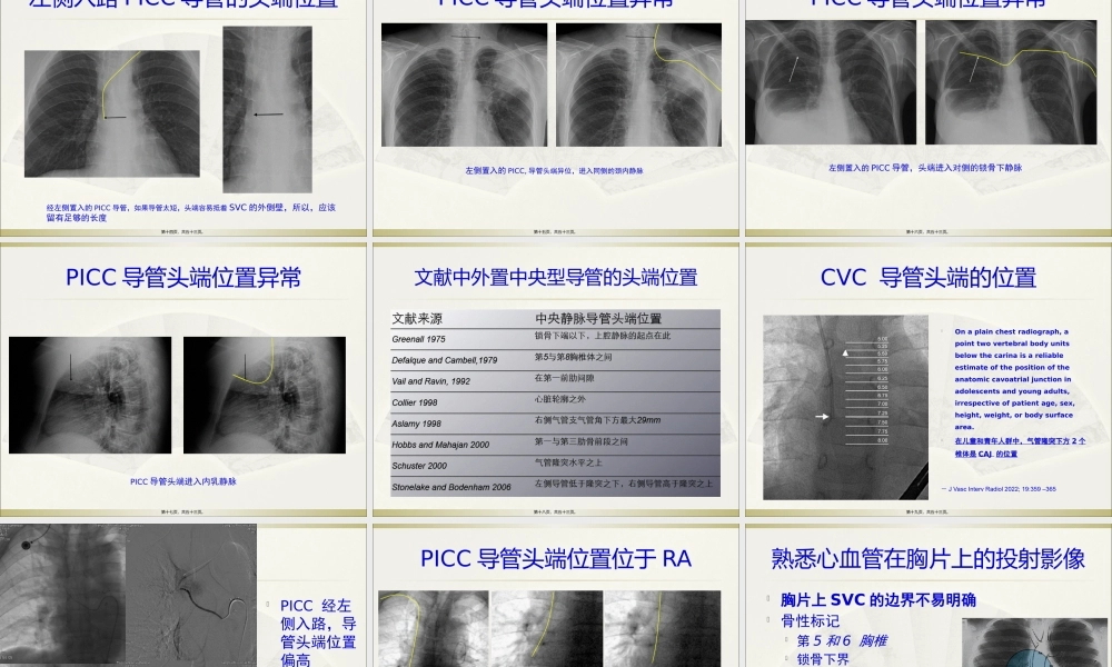 PICC导管头端定位与并发症处理.pptx