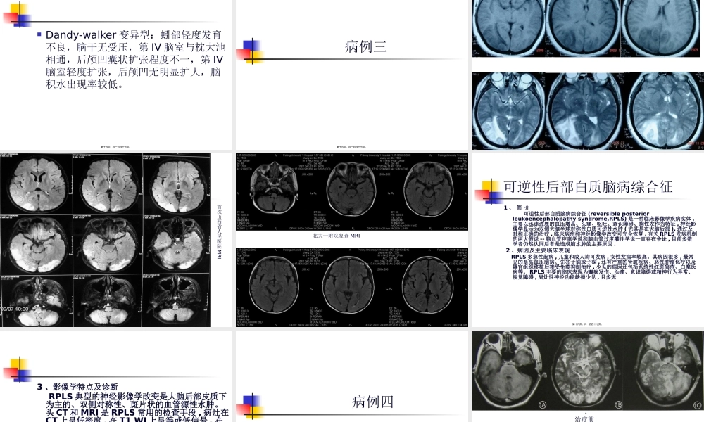 MRI颅脑典型病例.pptx
