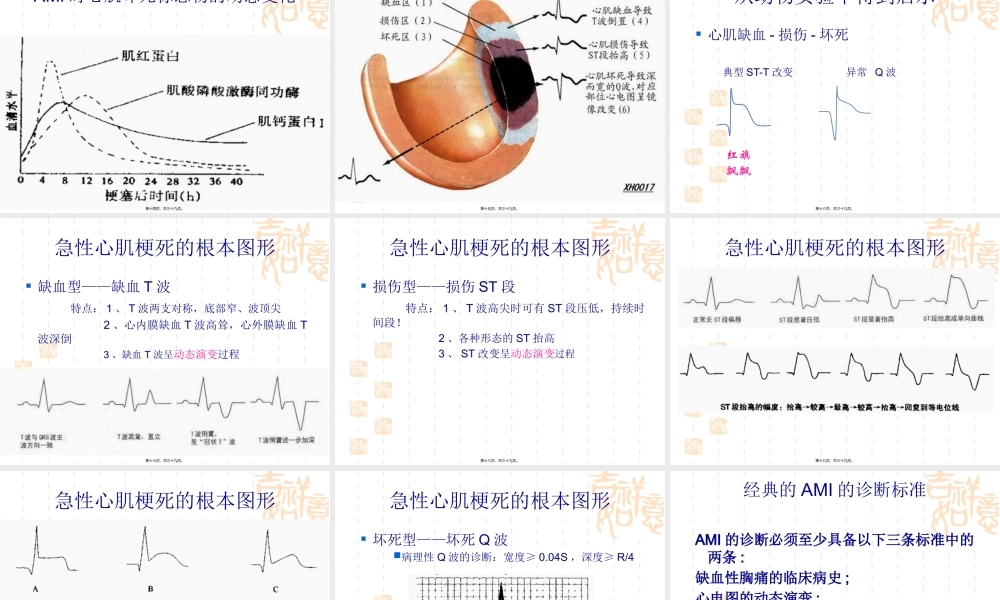 STEMI心电图识别和急诊PCI.pptx