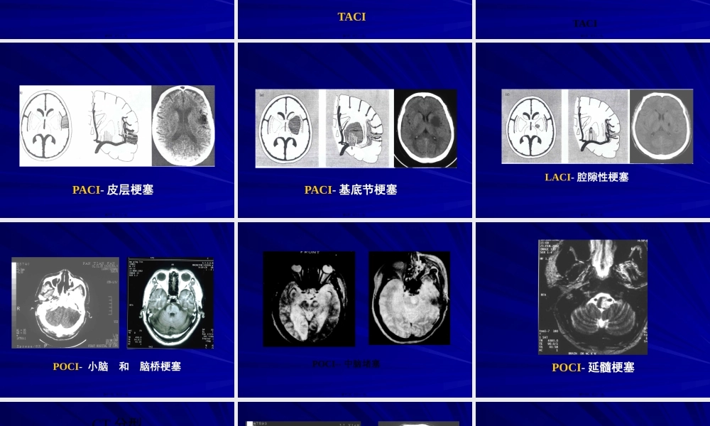 TOAST缺血性卒中分型.pptx