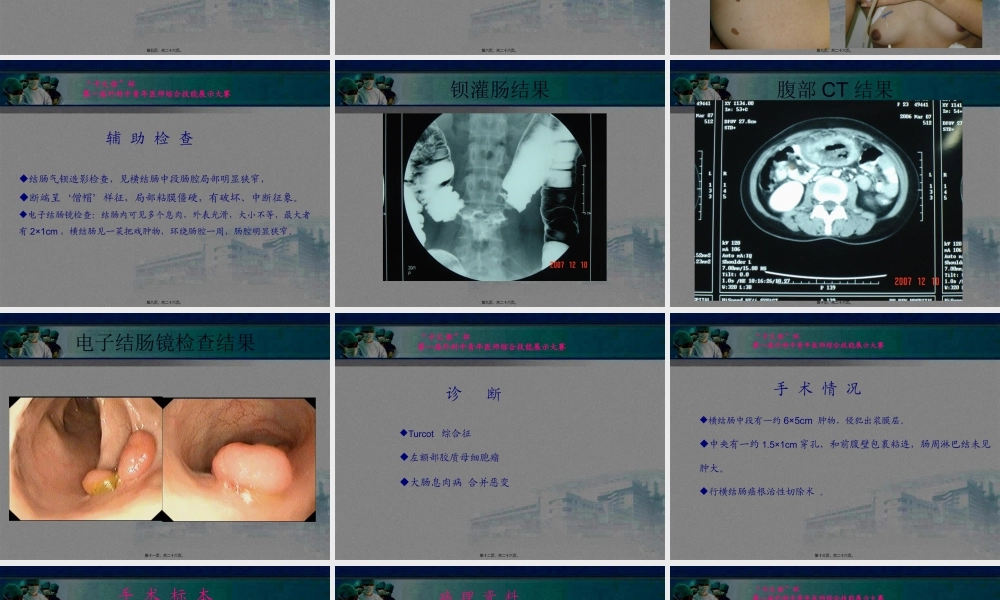 Turcot综合症.pptx