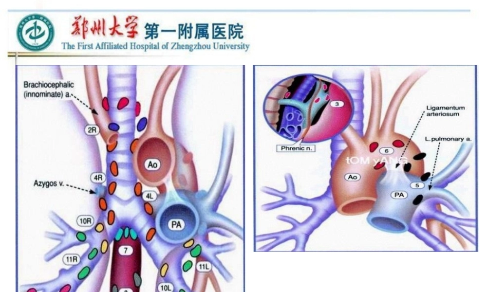 VATS左侧肺癌根治术中的淋巴结清扫---胸外科.pptx