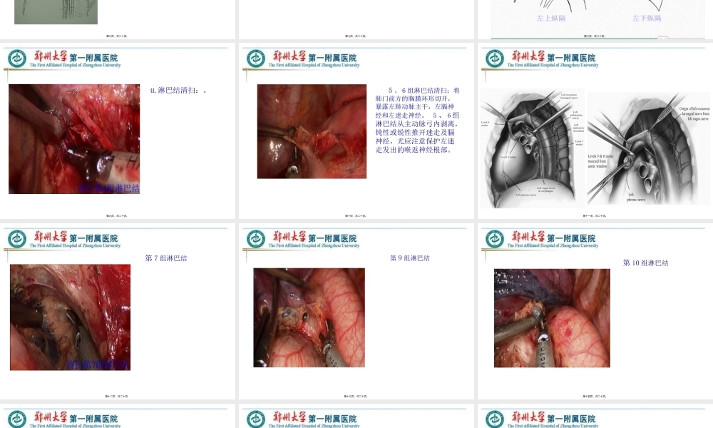 VATS左侧肺癌根治术中的淋巴结清扫---胸外科.pptx