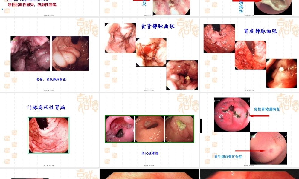 xxxttt上消化道出血.pptx