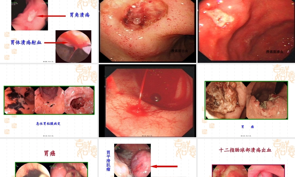 xxxttt上消化道出血.pptx