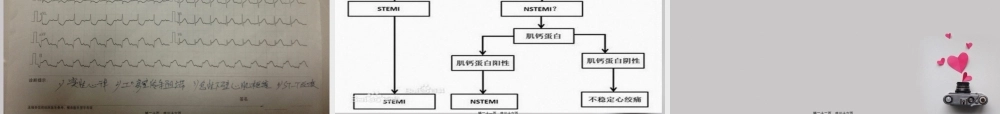 一例急诊心梗心跳骤停复苏成功案例查房.pptx