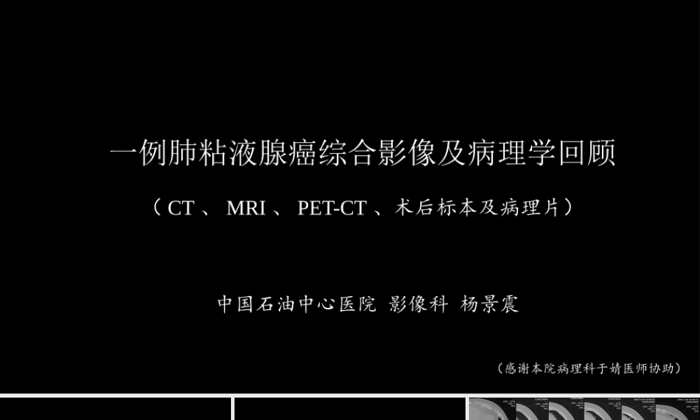 一例肺粘液腺癌综合影像及病理学回顾(1).pptx