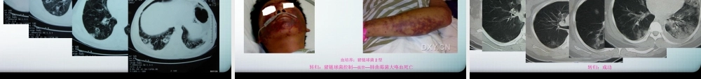 丁香园感染精彩病例综述.描述.pptx