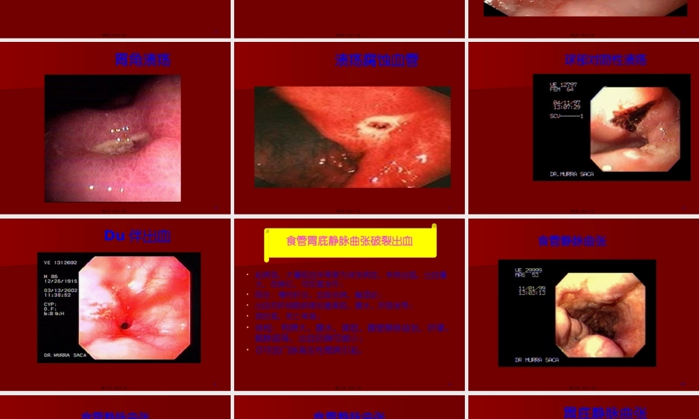 上消化道出血33.pptx