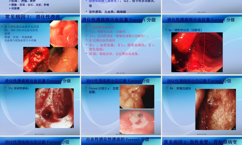 上消化道出血的诊治概要.pptx