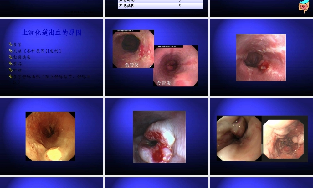 上消化道大出血的诊治.pptx
