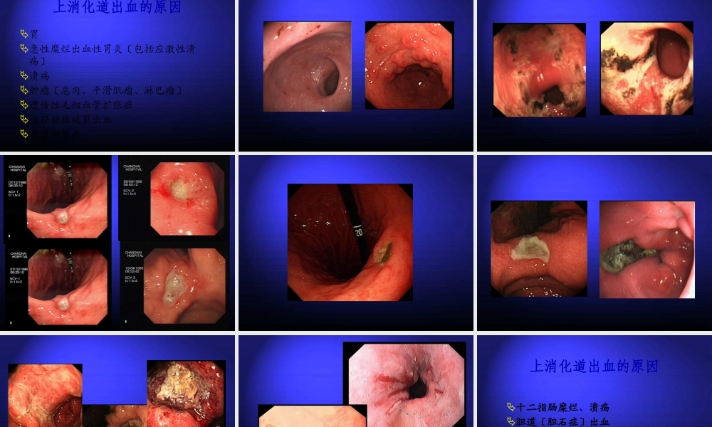 上消化道大出血的诊治.pptx