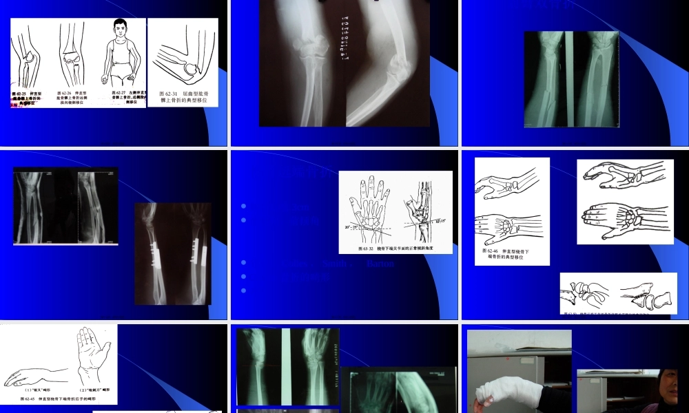 上肢下肢骨折.pptx