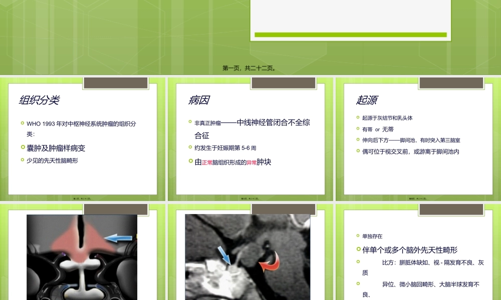 下丘脑错构瘤.ppt