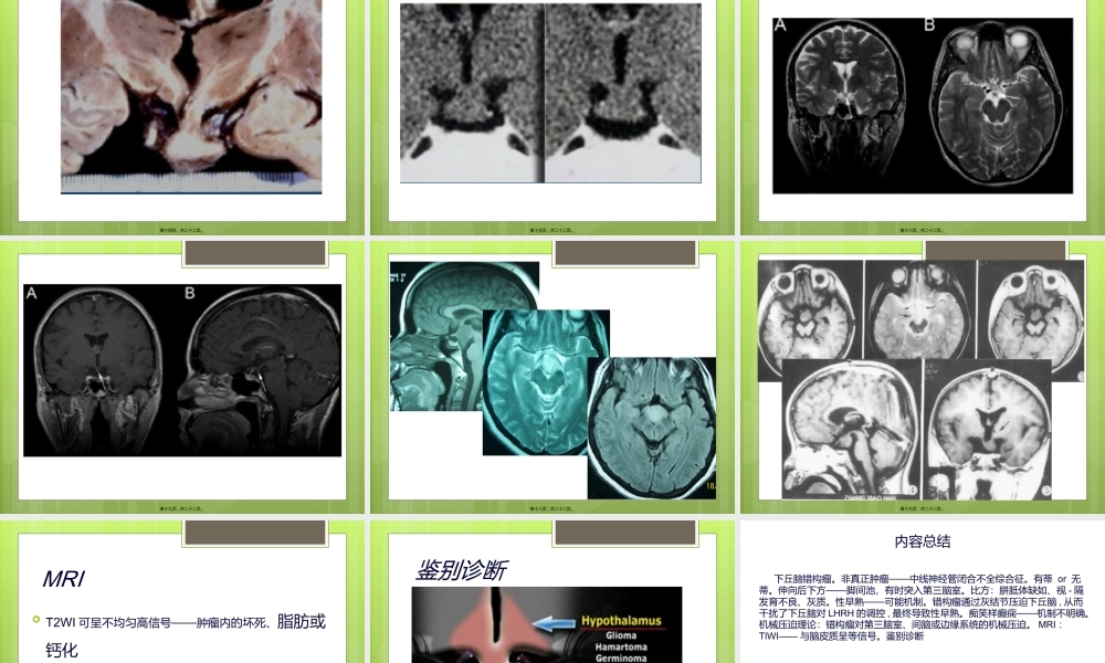 下丘脑错构瘤.ppt