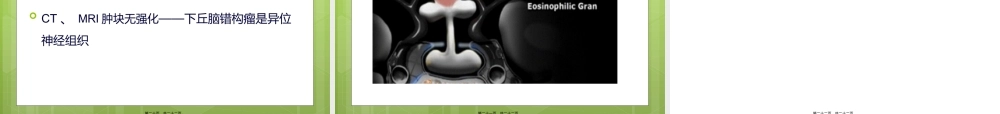 下丘脑错构瘤.ppt